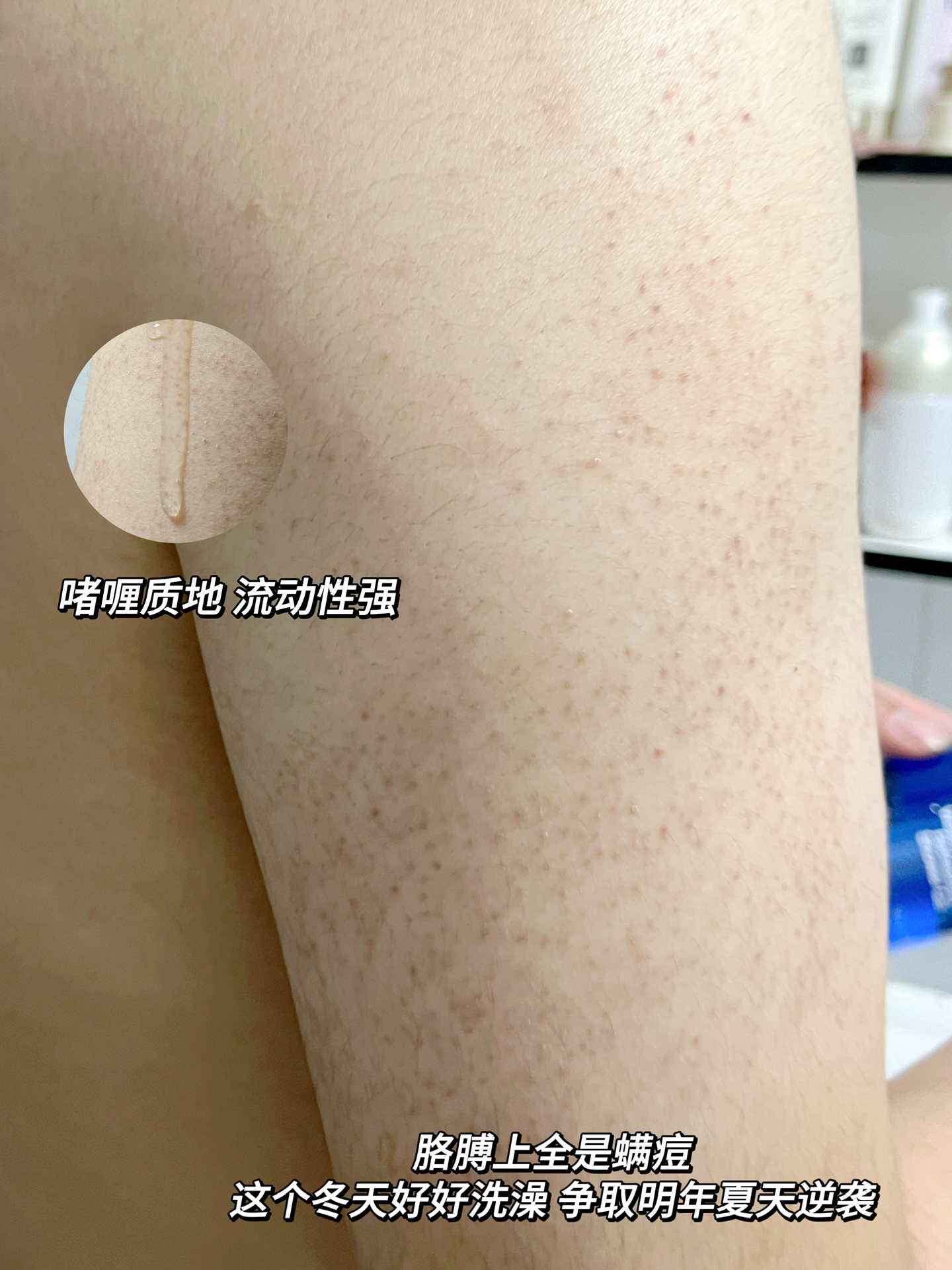 确认就男朋友两个胳膊上长满了这种红疙瘩
不疼不痒的 但是看起来真的