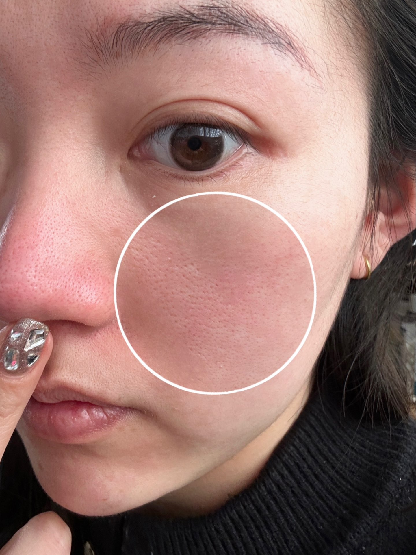 女生这么大毛孔还有救嘛?