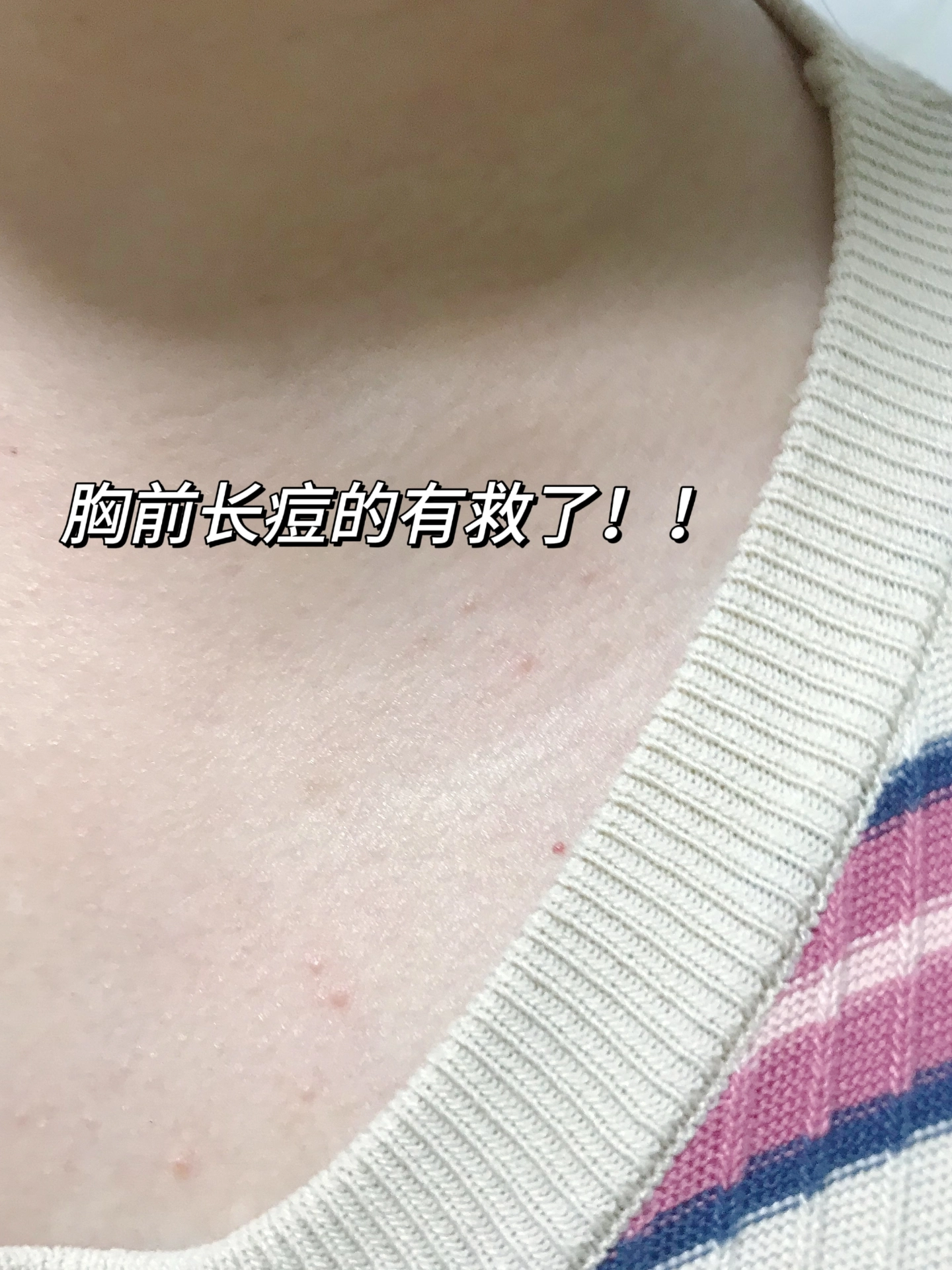 胸前的痘痘我教你怎么祛