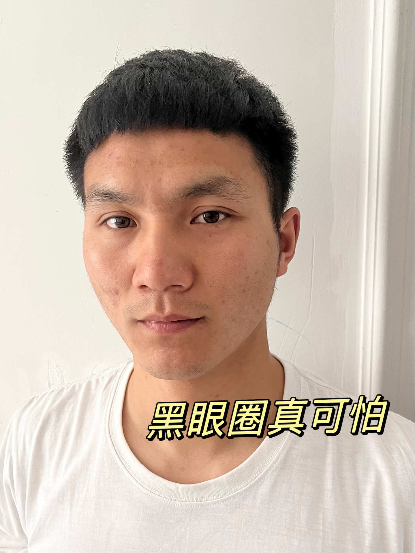 熬夜党的黑眼圈还有救吗