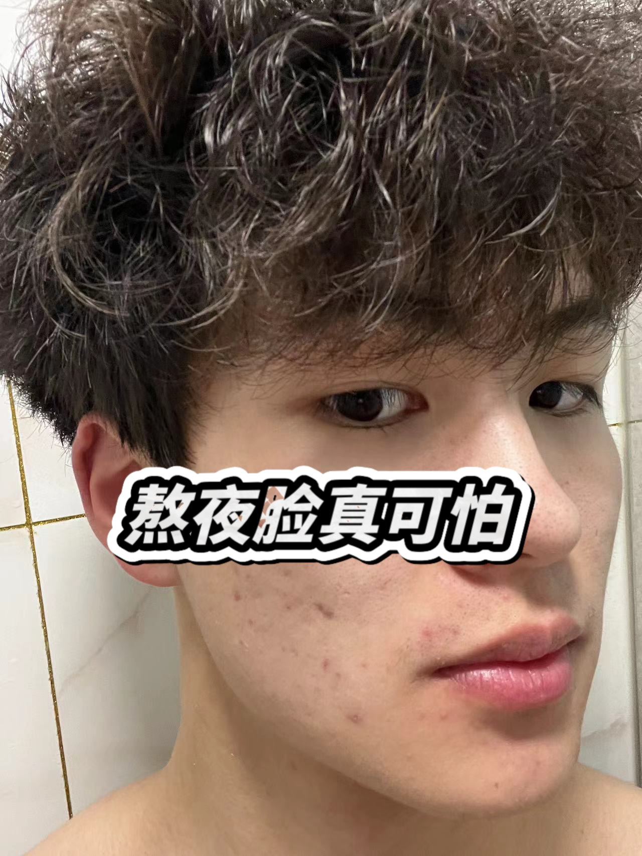 熬夜为什么会长痘痘为什么在线