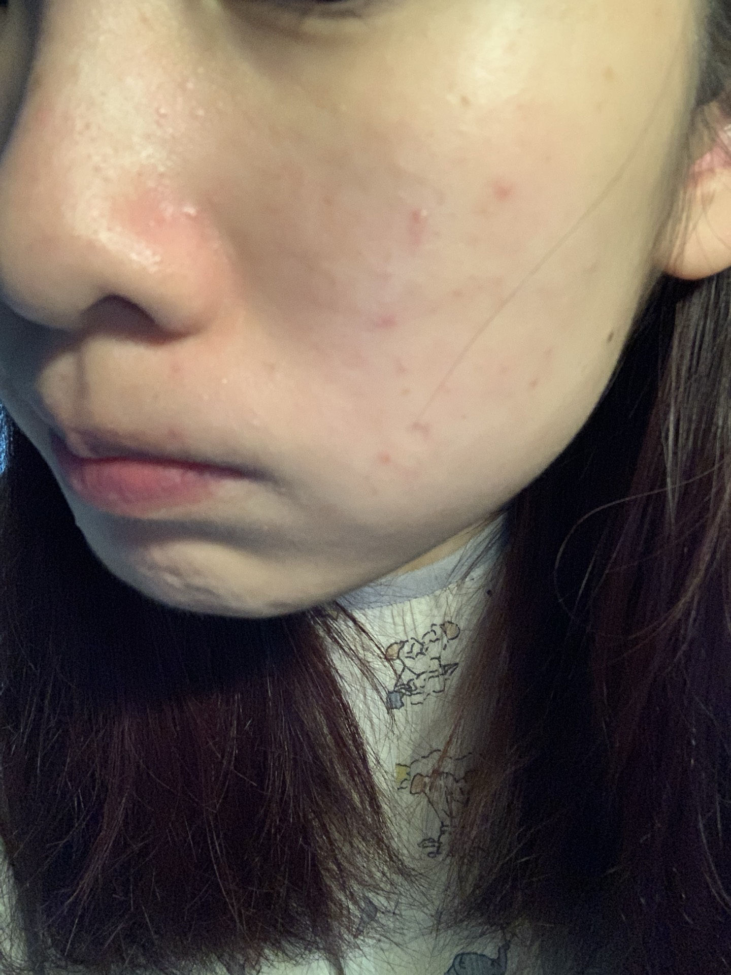 痘痘脸怎么办