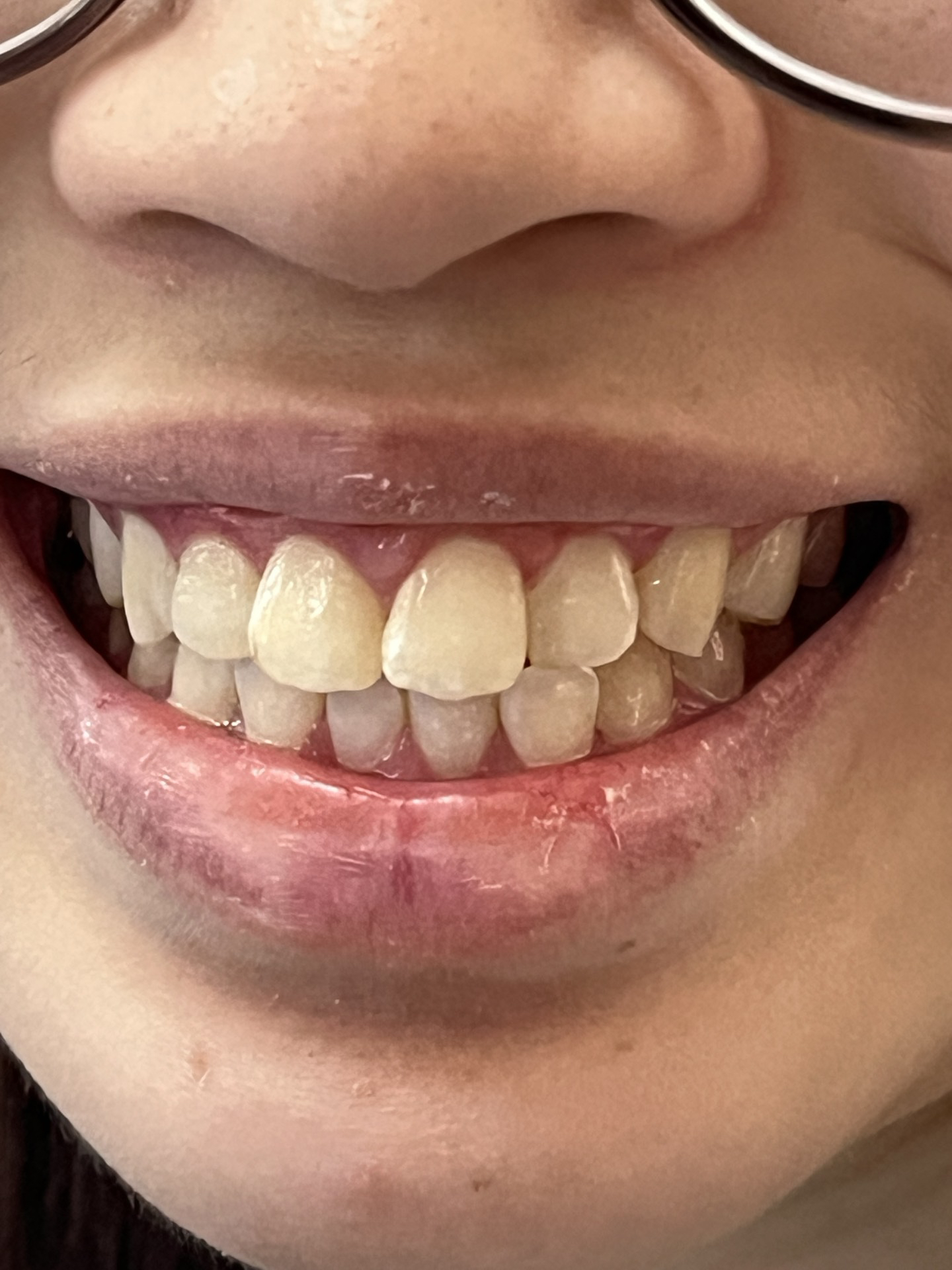 给牙齿来一场净齿行动