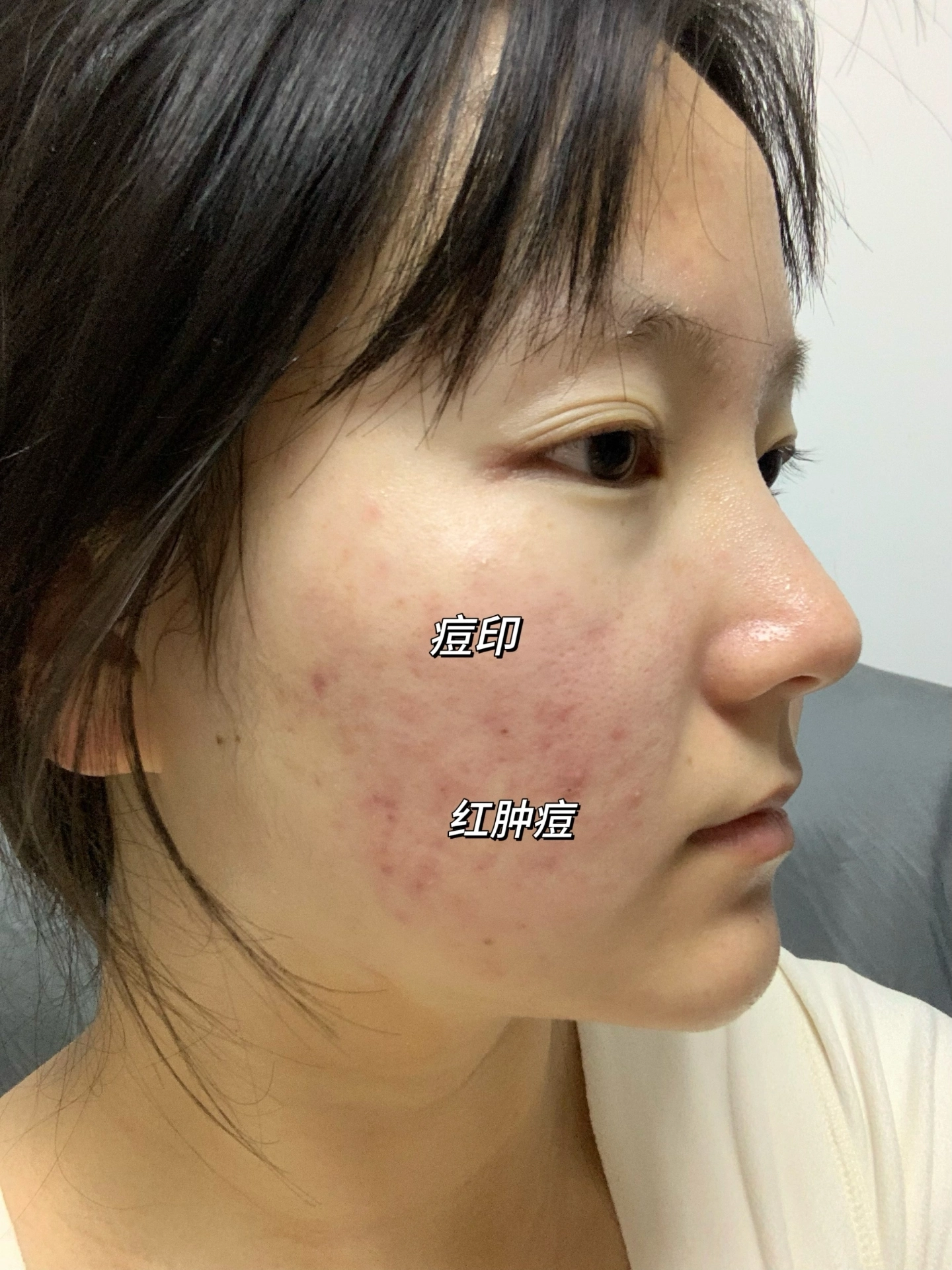 祛痘印成功上岸了吗?