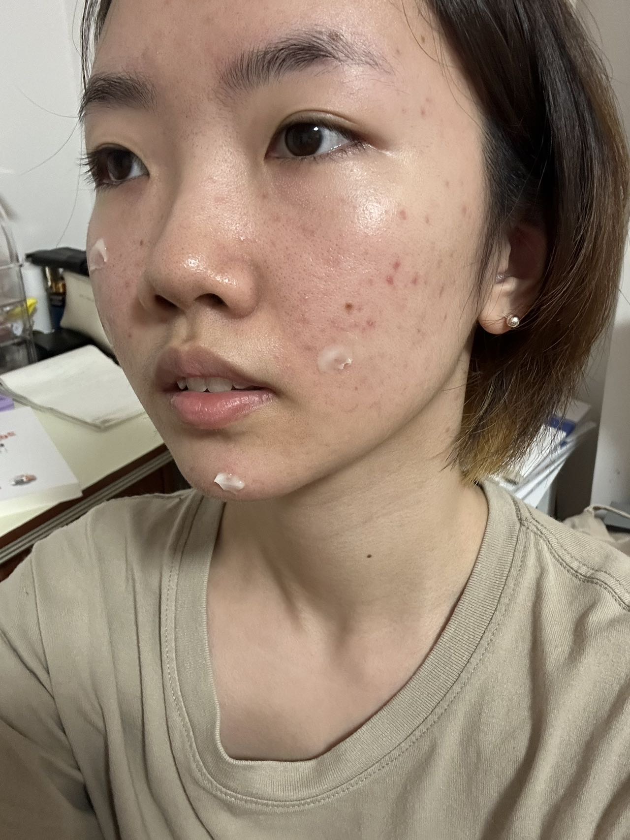 脸上有痘痘的女生看过来!