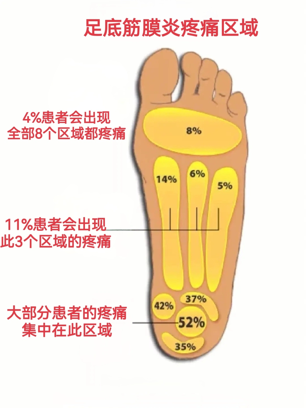 足底筋膜炎解剖图图片