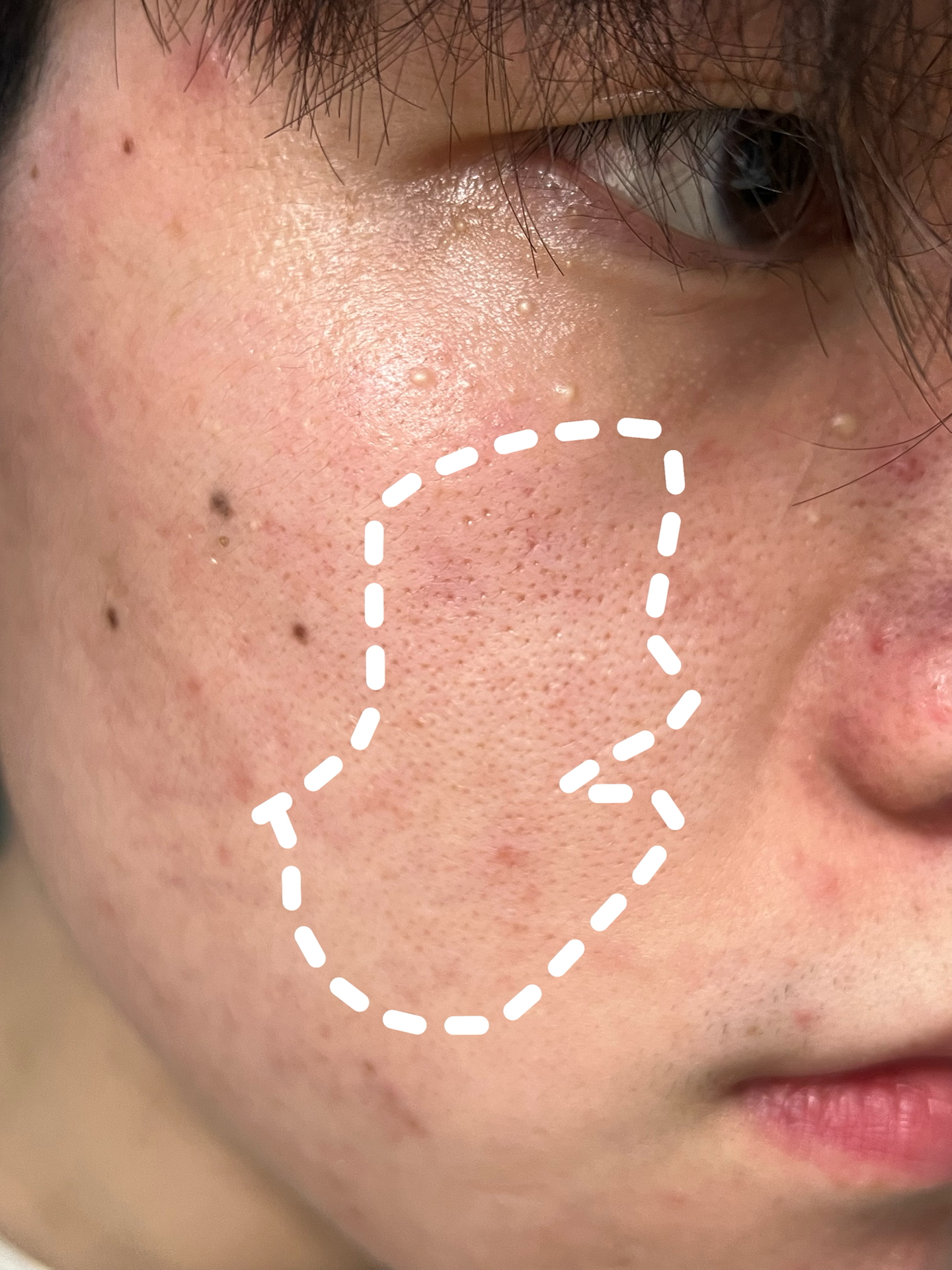 痘印脸别着急!瑕疵脸有救了!