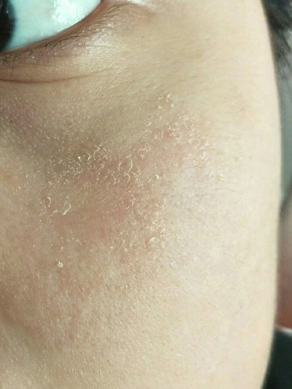 我是干皮,我平时用洗面奶用完脸上会干的起皮