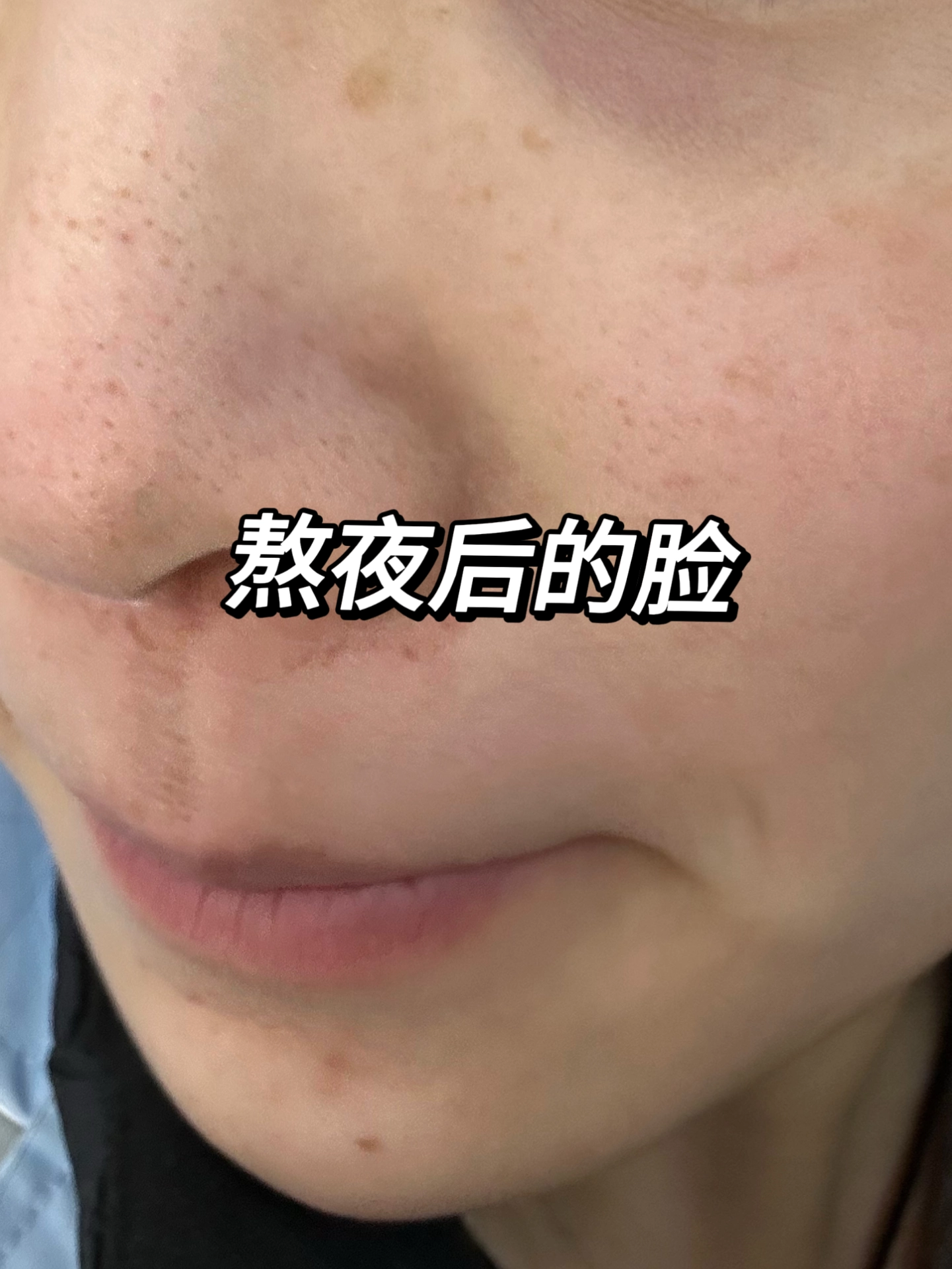 过年这段时间吃的比较油腻 脸上出油 长了好多小痘痘跟闭口
最近入手